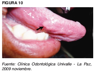 Una Verruga Blanca En La Lengua Clearance Dakora Com Co